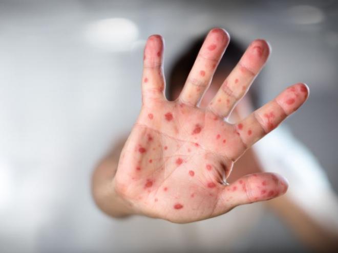 Уже більше 5 тисяч українців захворіли на кір з початку року. Захистити від захворювання може лише вакцинація