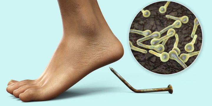 Правець: смертельна «хвороба подряпин»