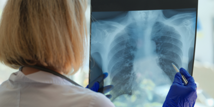 Позалегеневий туберкульоз: що варто знати про симптоми, діагностику і лікування